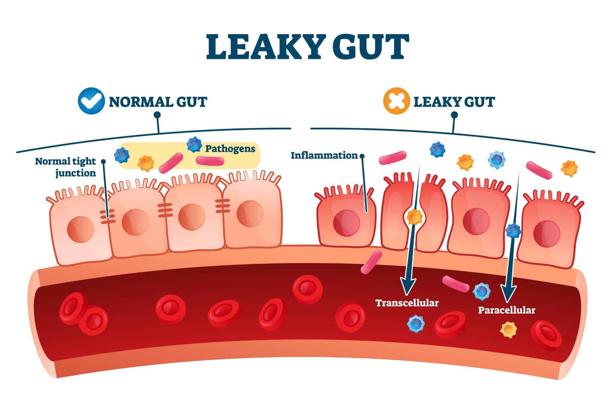 Leaky Gut 10 Signs You May Have It And What You Can Do To Fix It