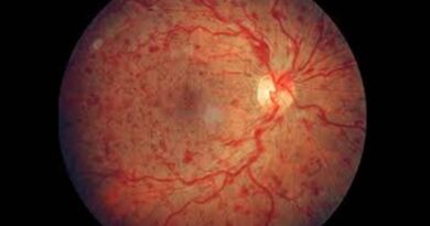 retinal vein occlusion