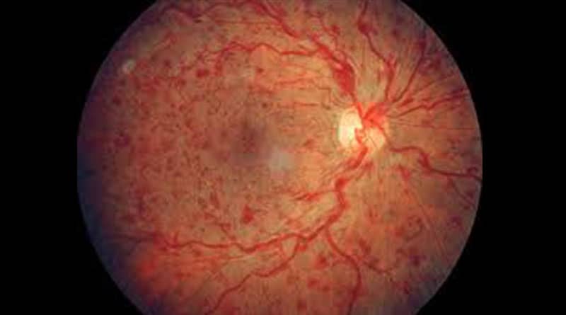 Retinal Vein Occlusion Symptoms Treatment And Prevention