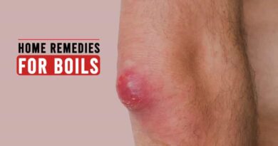 Home Remedies for Boils