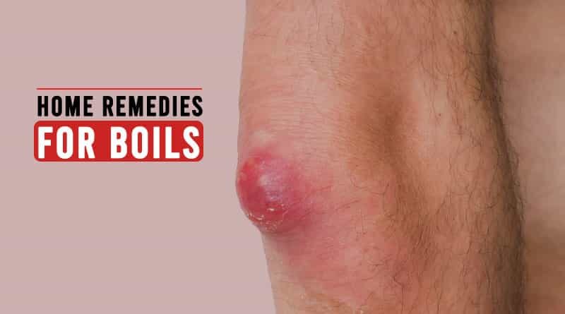 Home Remedies for Boils