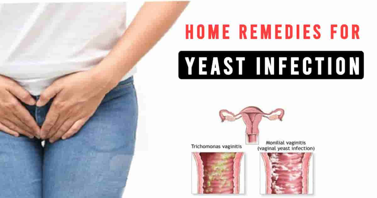 home remedies for yeast infection