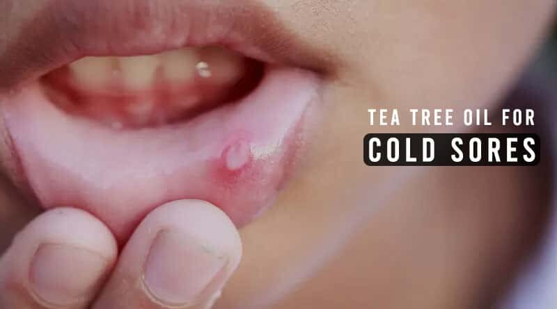 Tea Tree Oil for Cold Sores