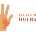 Tea Tree Oil for Burns