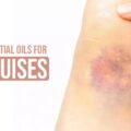 Essential Oils for Bruises