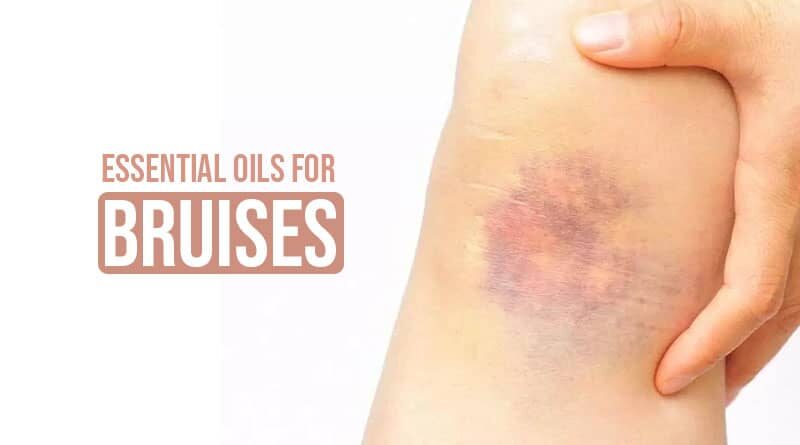 Essential Oils for Bruises