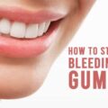 How to Stop Bleeding Gums