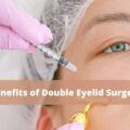 Benefits of Double Eyelid Surgery