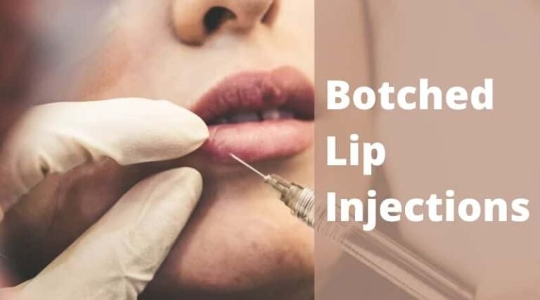 ️What are Botched Lip Injections? | HealthtoStyle