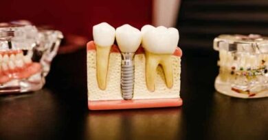 How Getting Dental Implants Work