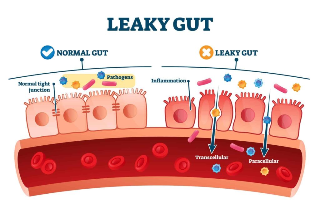 What Is Leaky Gut Syndrome